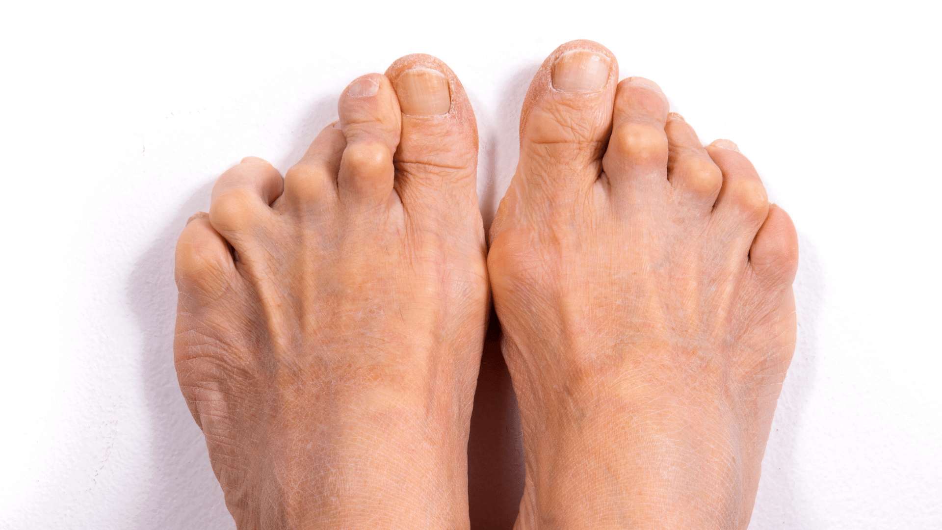 Rheumatoid-arthritis Rheumatoid-arthritis